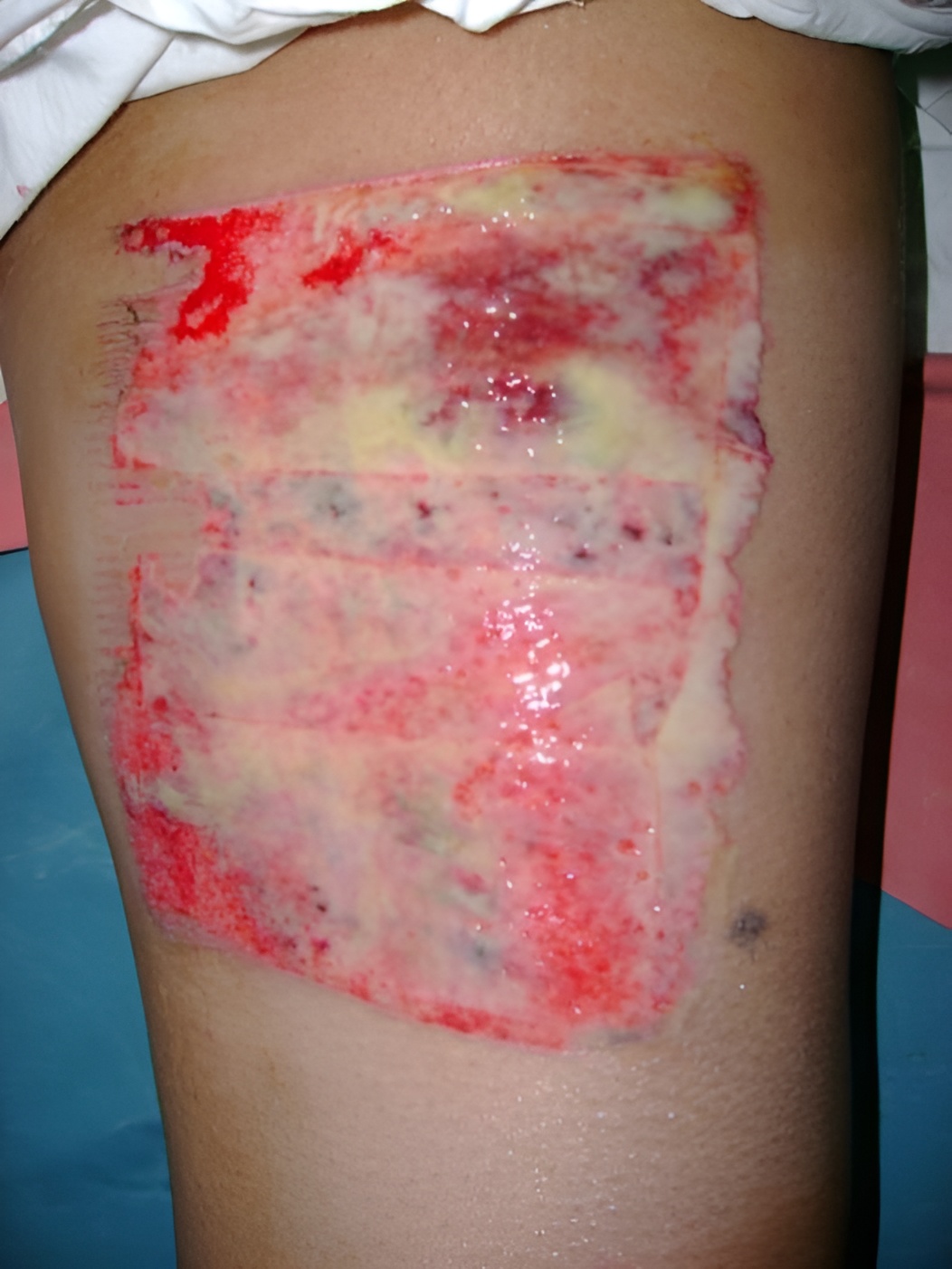 Soft tissue repair, Day 3
