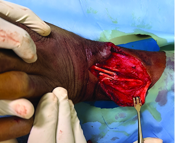 Repaired extensor digitorum communis tendons in zone 8
