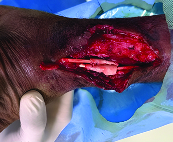 HPTC wrap around the repaired tendons
