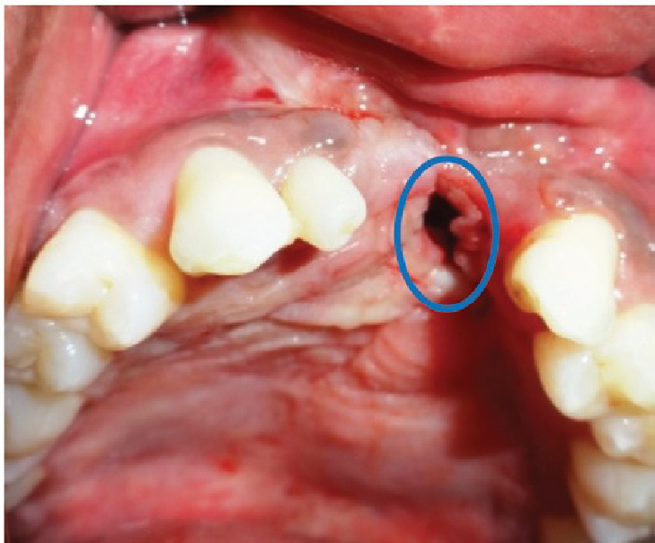 Oronasal fistula in the anterior palate