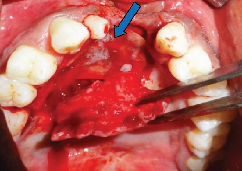 Collagen membrane placed over repaired nasal layer
