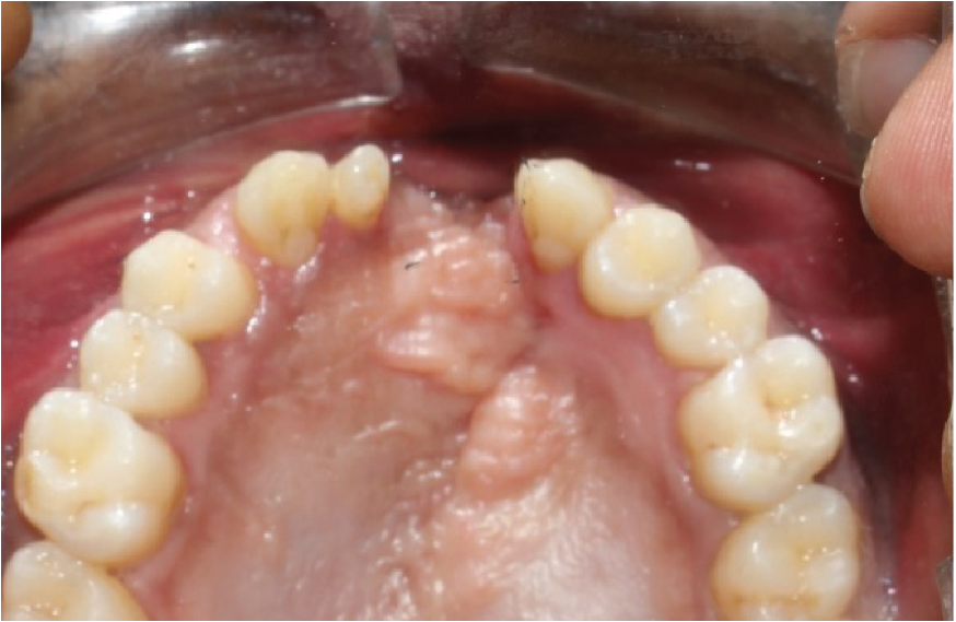 Post-op 6 months No recurrence