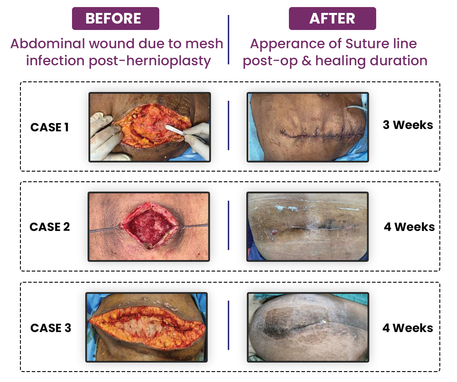Clinical Outcomes using Surgicoll-Mesh