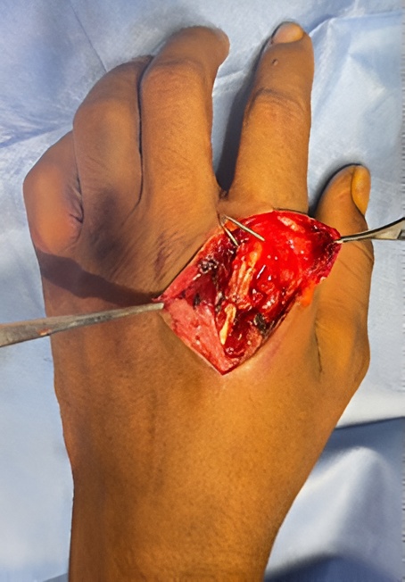 Repaired extensor digitorum to index finger in zone 6