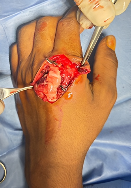 HPTC wrap around the repaired tendon