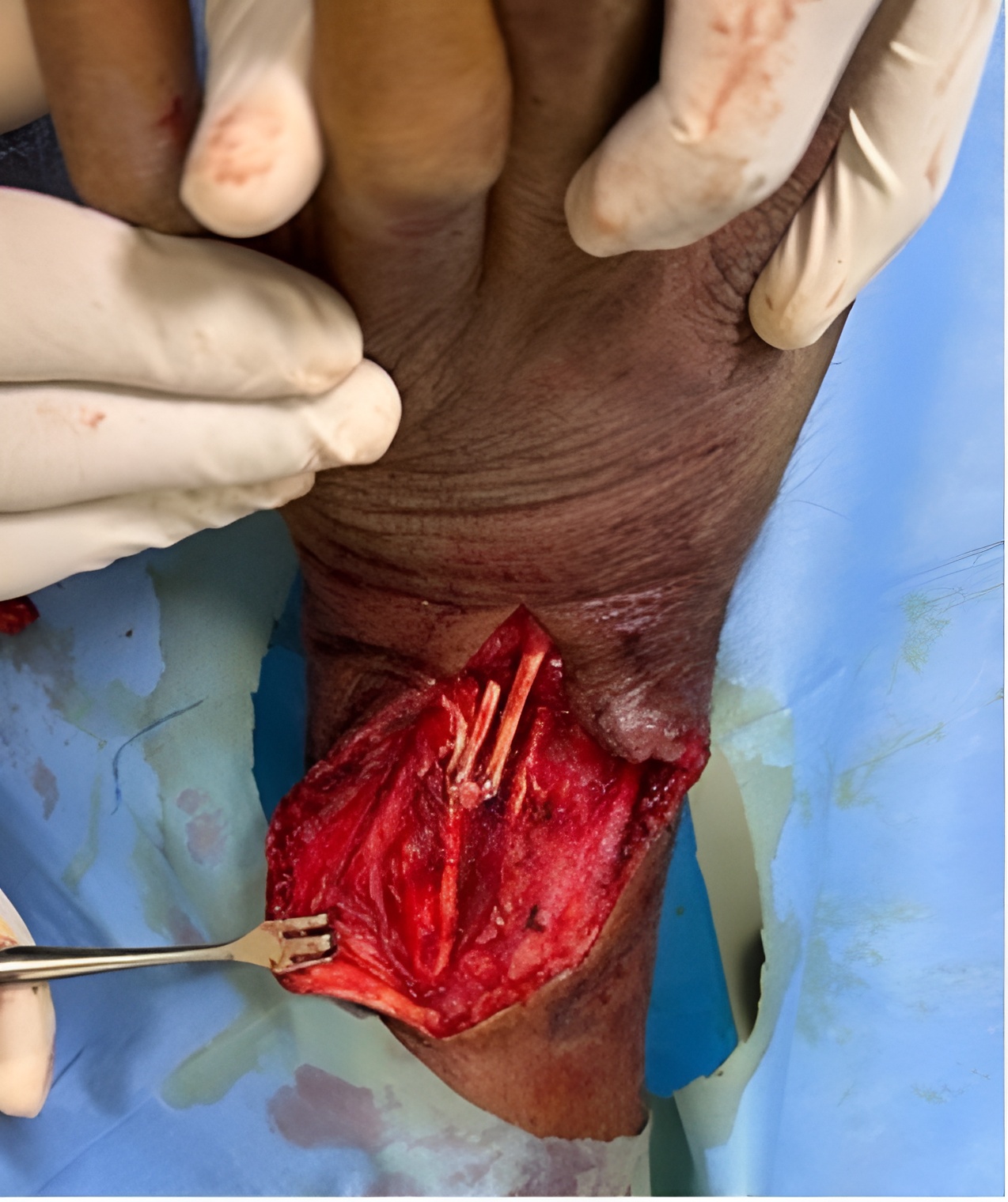 Repaired extensor digitorum communis tendons in zone 8