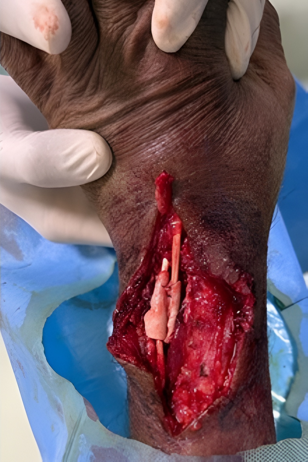 HPTC wrap around the repaired tendons